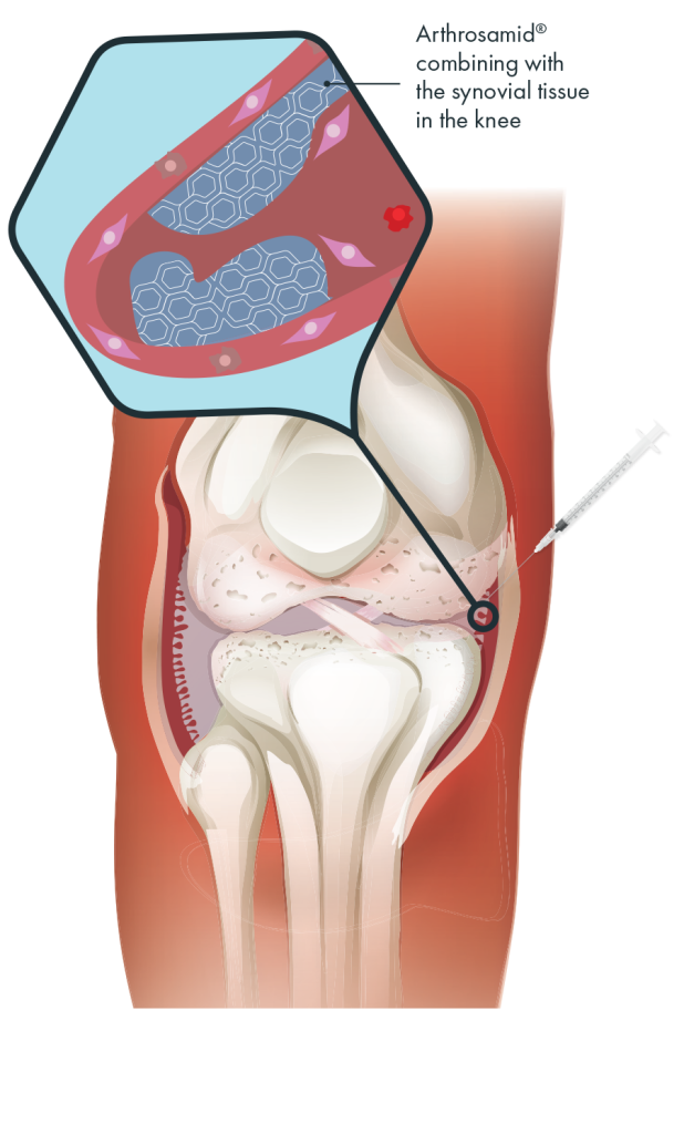 Diagram showing how Arthrosamid hydrogel integrates with the synovial tissue of the knee joint