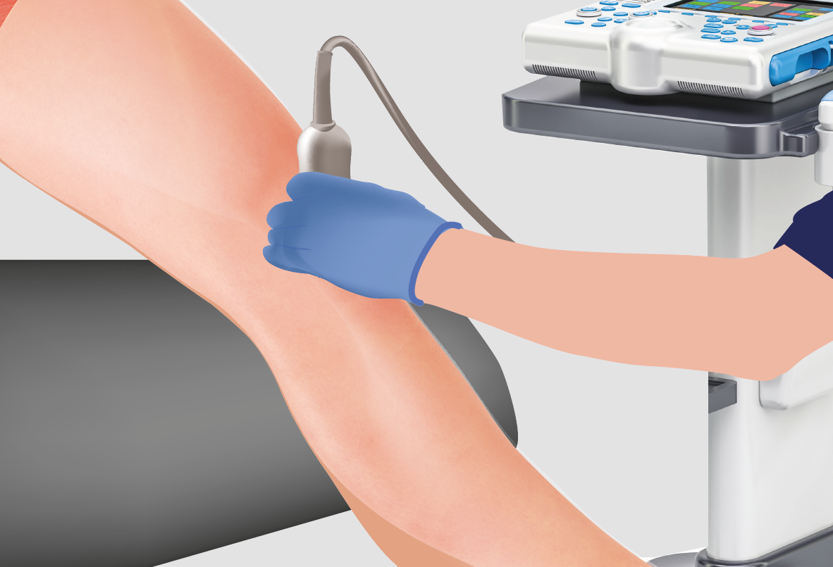 Arthrosamid single injection procedure for knee osteoarthritis performed under local anaesthetic