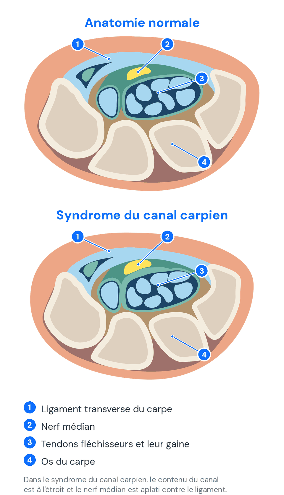 Schéma du canal carpien : anatomie normale et syndrome du canal carpien, avec le nerf médian comprimé