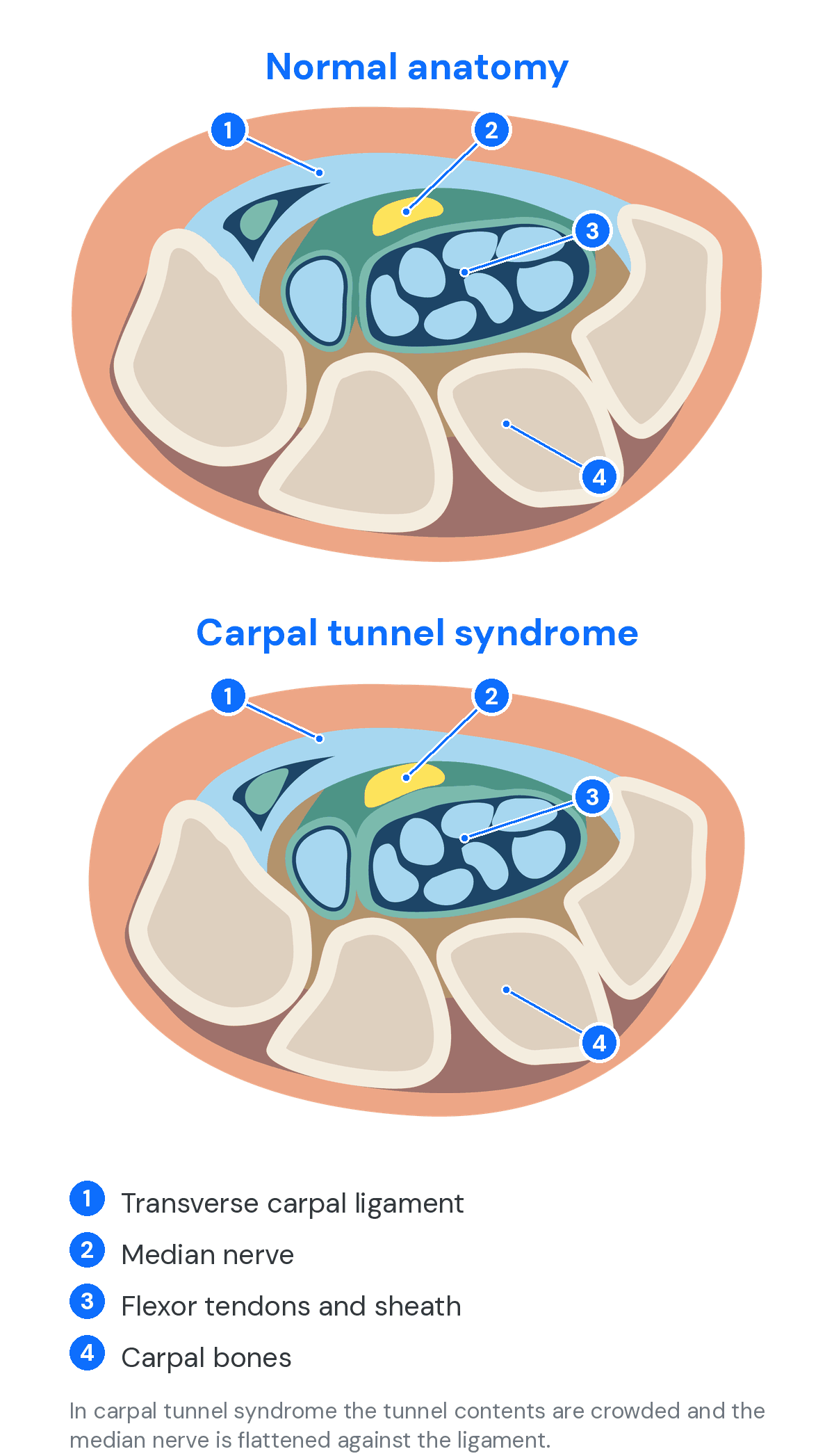 Cross section of the wrist comparing normal carpal tunnel anatomy with carpal tunnel syndrome, labelling the transverse carpal ligament, median nerve, flexor tendons and sheath, and carpal bones